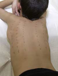 Testing For Allergies allergy Testing
